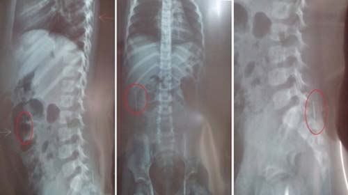 Padrasto é suspeito de espetar agulhas em criança de três anos durante ritual macabro