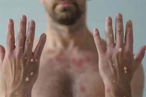 Sesau confirma o 2º caso de varíola dos macacos em Alagoas