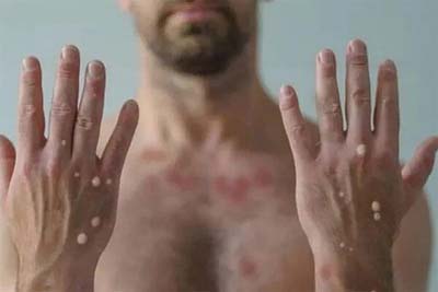 Mais três casos suspeitos de monkeypox são notificados pela Sesau, em Alagoas