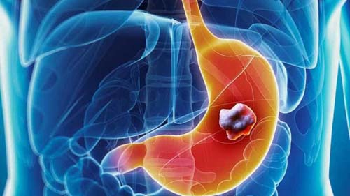 Câncer que atinge Bruno Covas aumenta entre os jovens