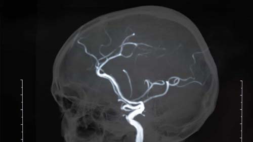 Saiba mais sobre o aneurisma cerebral e as consequências à saúde