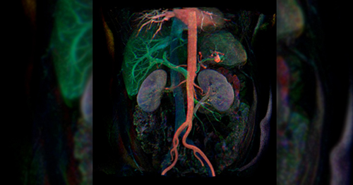 Estudo aponta enzimas que promovem o enfraquecimento da aorta abdominal