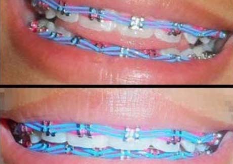 Aparelho dentário irregular pode causar até perda de dente, diz dentista