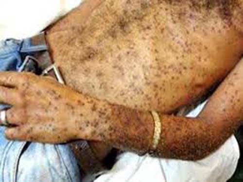 Ataque de abelhas deixa 25 pessoas feridas durante aula de campo em São José da Tapera