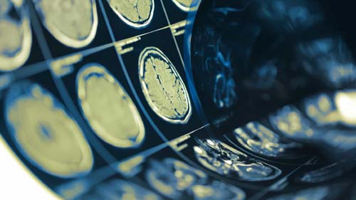 OMS: longa jornada de trabalho eleva risco de morte por AVC e doenças cardíacas