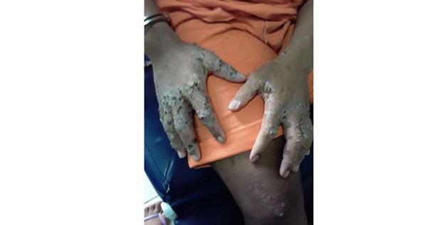 Detentos são 'comidos vivos' por bactéria desconhecida em Roraima