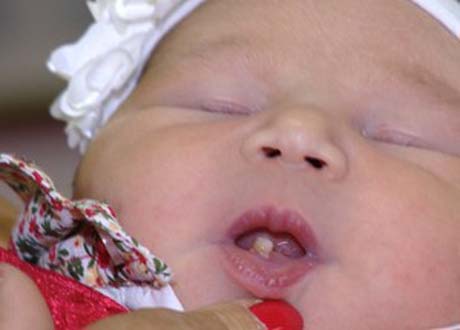 Em caso raro, bebê nasce com dente formado em Santa Maria