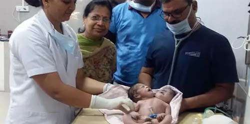 Bebê indiano nasce com duas cabeças e três braços