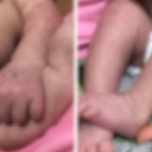 Recém-nascido morre de dengue em Maceió