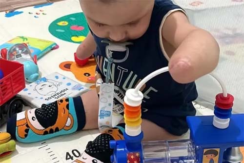 Família de bebê de Murici busca ajuda após múltiplas paradas cardíacas e amputações