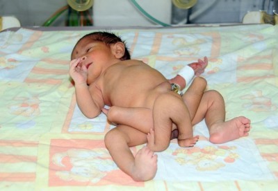 Médicos tentam salvar bebê de seis pernas