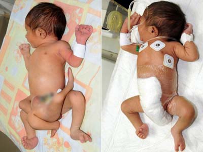 Bebê que nasceu com seis pernas no Paquistão é operado com sucesso