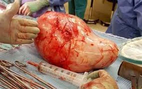 Cisto no ovário: o que é, tipos, sintomas e tratamento