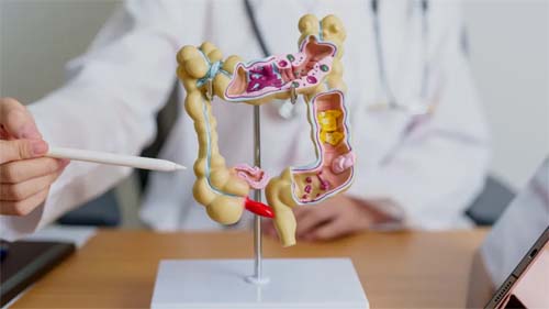 Câncer colorretal, como o de Preta Gil, cresce entre pessoas com menos de 50 anos