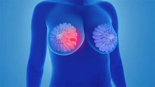 Dados revelam que quase metade dos cânceres globais podem ser prevenidos