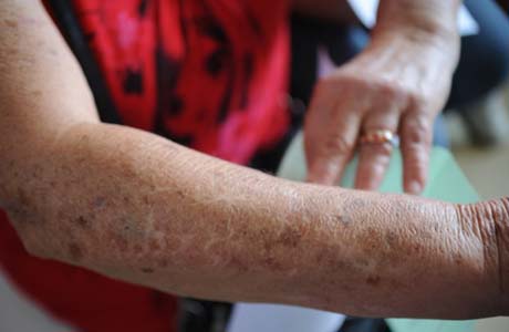 Câncer de pele: prevenção ainda é a melhor forma de combate