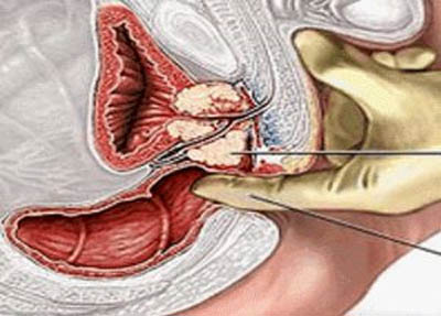 Exame de sangue pode diagnostica câncer de prostata, diz revista