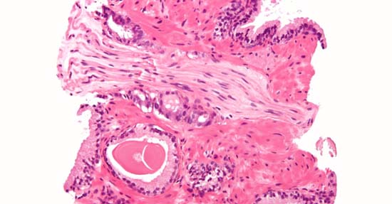 Exame de saliva para detectar câncer de próstata entra em fase de teste