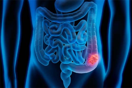 Estratégias Cruciais para Diminuir a Probabilidade de Câncer Intestinal