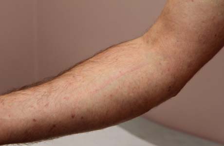Sarcoma: saiba tudo sobre o tipo de câncer que atinge tecidos