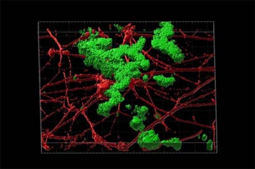 Alzheimer: pesquisadores usam células da pele para criar novo tratamento