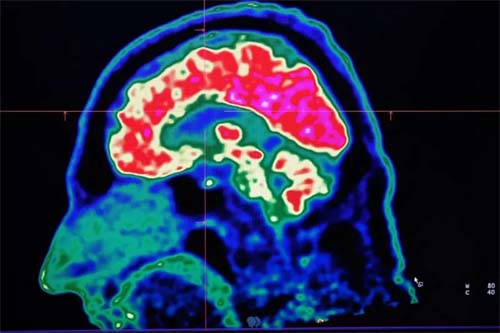 Impactos do Aquecimento Global na Saúde Cerebral e Neurodegeneração