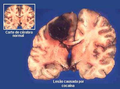 Remédio usado no tratamento a diabetes tipo 2 combate consumo da cocaína