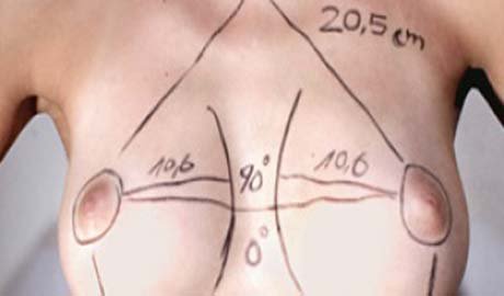 O que esperar da cirurgia de reconstrução da mama?