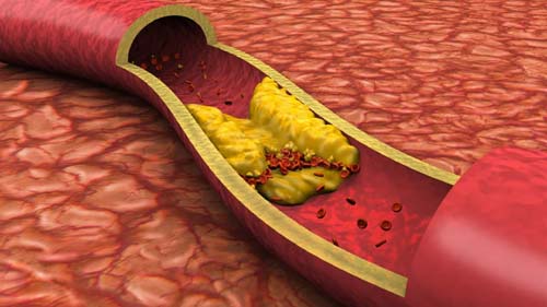 Colesterol alto é fator de risco para doenças cardiovasculares