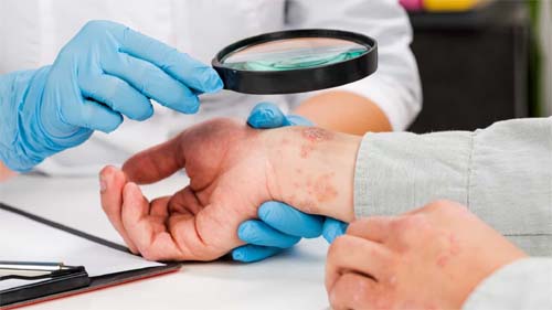 Sintomas de colesterol alto que se manifestam na pele