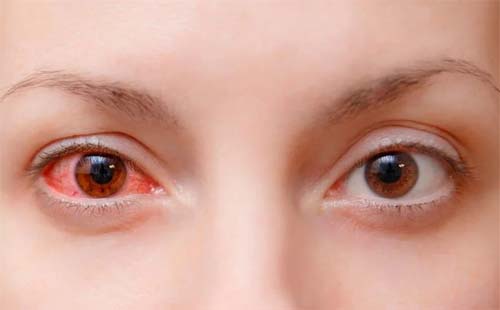 Aumento de Casos de Conjuntivite nas UPAs de Maceió Alerta para Precauções