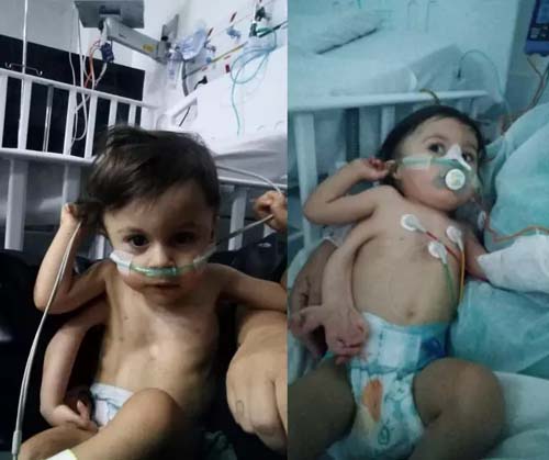 Em caso raríssimo, bebê com três braços passa por amputação