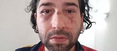 'Na boca foi com soco inglês': músico detalha agressões sofridas por grupo suspeito de ser neonazista em SP