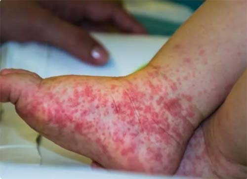 Saiba os sintomas da doença mão-pé-boca, que está causando surto em cidades do Brasil