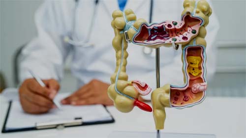 Cinco fatos essenciais sobre doenças inflamatórias do intestino que você precisa conhecer