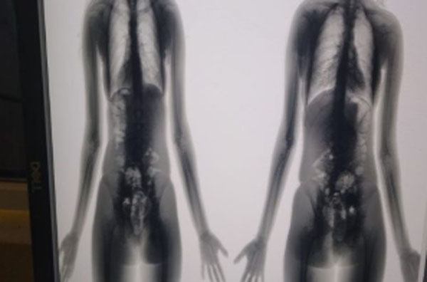 Jovem tenta entrar com droga escondida nas partes íntimas no Presídio do Agreste