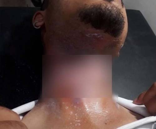 Entregador de pizza fica ferido ao ser atingido por cabo de energia solto em rua