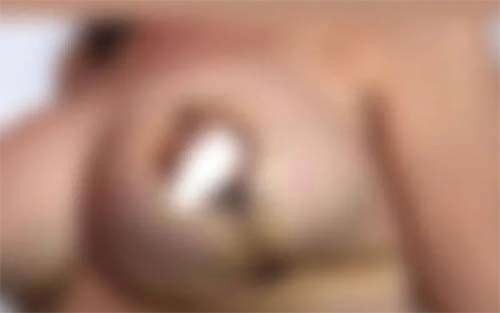 Mais de 20 mulheres denunciam suposto erro médico em cirurgias plásticas, em Maceió