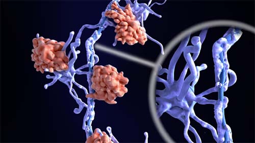 Avanços na Diagnóstica da Esclerose Múltipla: IA Revela Dois Novos Perfis Biológicos