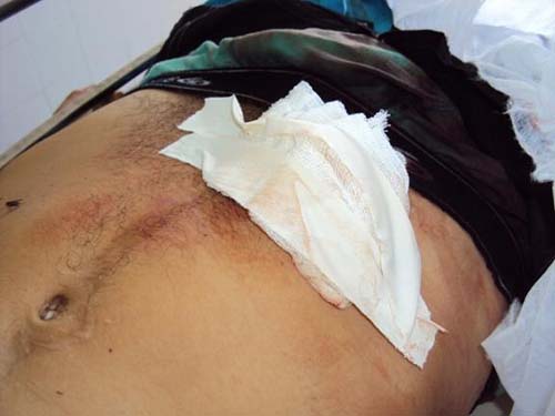Homem é esfaqueado pela namorada no Dia dos Namorados