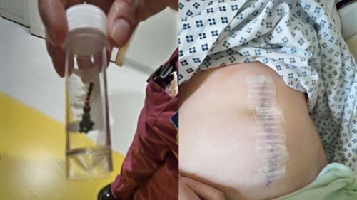 Garota de 13 anos tem parte do intestino removido após fazer desafio do TikTok
