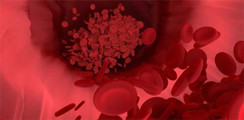 Como uma combinação de fatores de risco favorece o acúmulo de gordura nos vasos