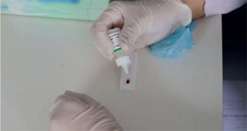 Paciente mantém remissão prolongada do HIV após estudo inovador, mas se reinfeta após 17 meses