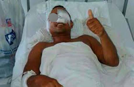 Soldado da PM leva tiro de raspão no olho durante assalto 