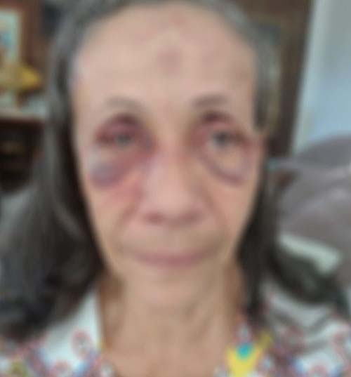 Com marcas de espancamento, mulher suspeita de matar o marido se apresenta à polícia