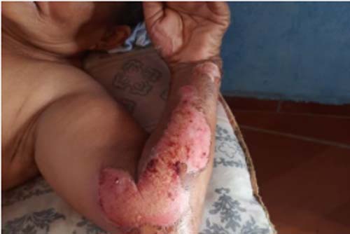 Agentes de saúde pedem pomada para idosa queimada viva pela filha em Arapiraca