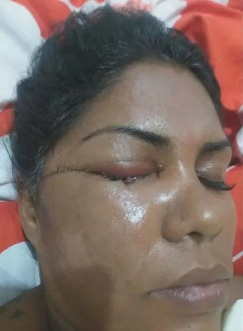 Intolerância religiosa: Manicure perde visão após ser agredida com facão por ouvir samba enredo em homenagem a Exu