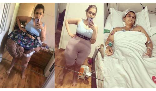 Médicos brasileiros retiram quase 35 kg de tumor de mulher com doença rara: 'Salvou a vida dela'