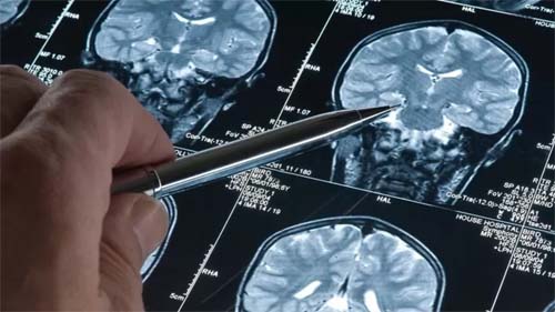 Lecanemab: medicamento experimental contra Alzheimer tem resultados 'históricos'