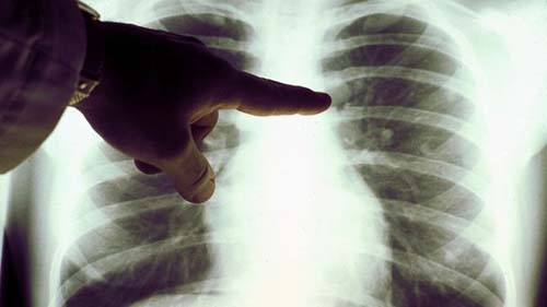 Coronavírus: o estranho caso da cura de um linfoma após infecção por covid-19